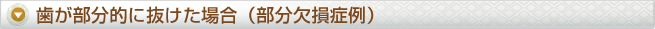 歯が部分的に抜けた場合（部分欠損症例）